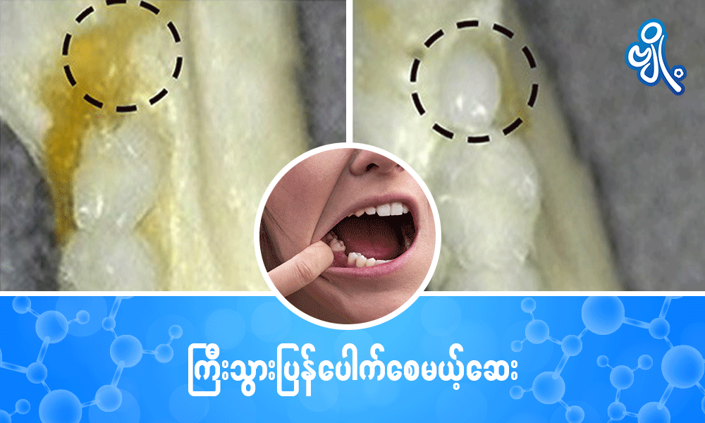 ကြီးသွားပြန်ပေါက်စေမယ့်ဆေး